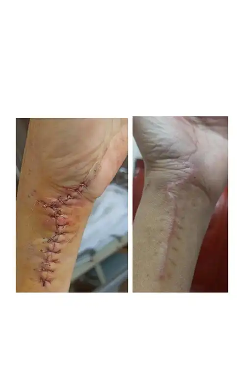 手术后三天与四十天的伤口对比