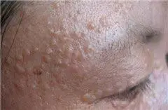 恶性小汗腺汗孔瘤