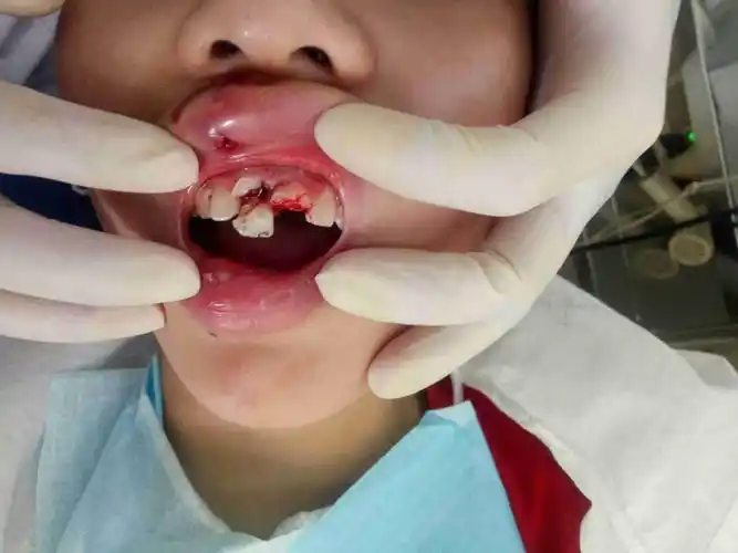 孩子12岁避让倒车 摔倒把门牙磕掉俩颗,裂缝俩颗