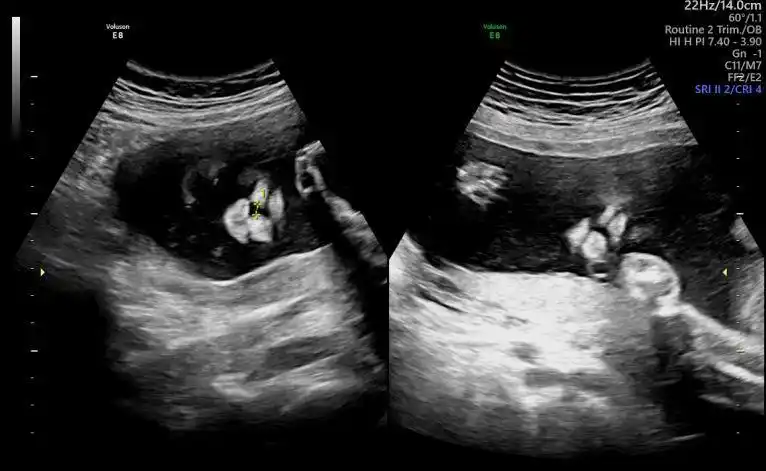 美国gee8超清四维彩超为安徽孕妈查出宝宝患有唇腭裂