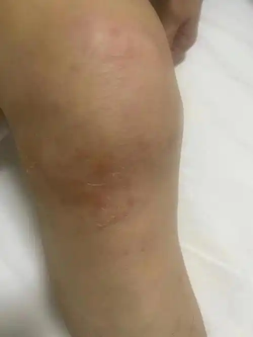 女士患滑膜炎膝盖积液,担心穿刺抽吸"越抽越多"?医生:多虑了