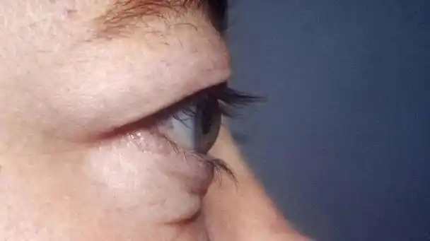 很多近视的朋友都会发现自己戴眼镜时间长了都有不同程度的外凸,如果