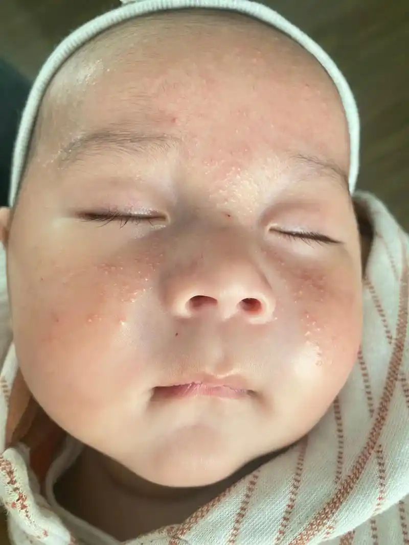 各位姨姨们,宝宝脸上的湿疹有没有好的办法啊,用了很 - 抖音