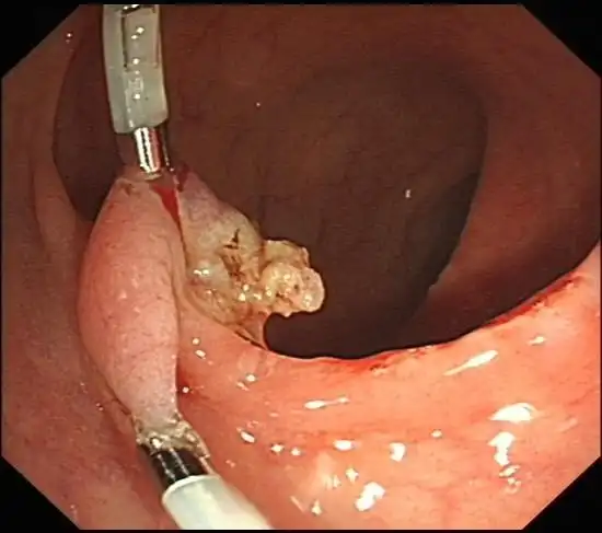于蒂部夹持钛夹肠道见一巨大息肉,有宽蒂.