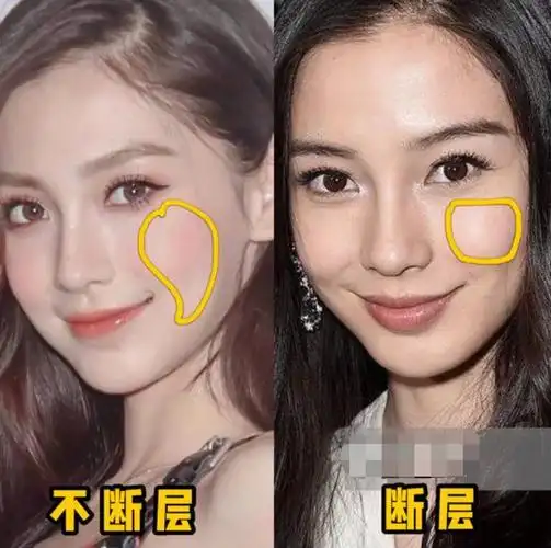 解析:苹果肌下垂是能恢复的,有提升前后对比图,你要看吗?