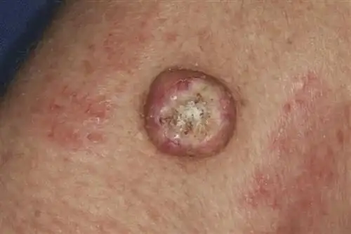 预防皮肤癌的有效途径