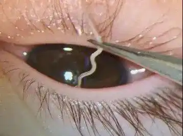 女童眼里取出6条"活虫",和家里的它有关_虫子_眼睛_医生