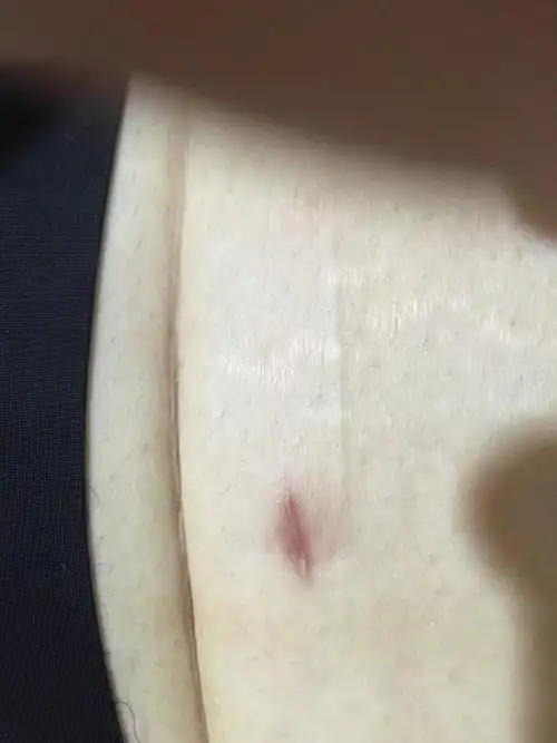这几天肚皮疼,做完腹腔镜手术半年了发现刀口有点发