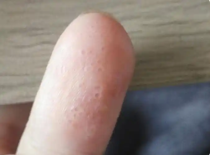 手上起小水泡,又痒又痒又脱皮怎么办,医生教你应对小妙招