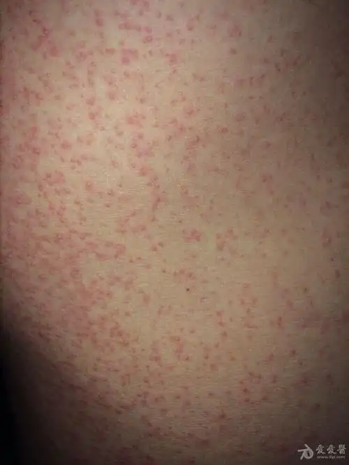 药疹or过敏性皮炎