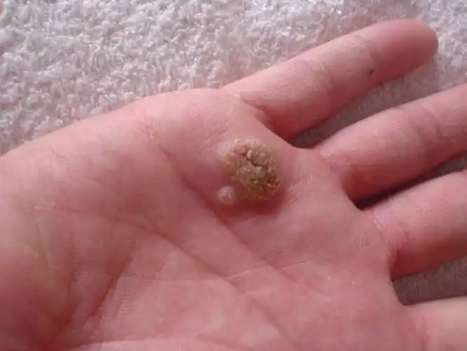 假尖锐湿疣状撞馐酝计琠有来医生