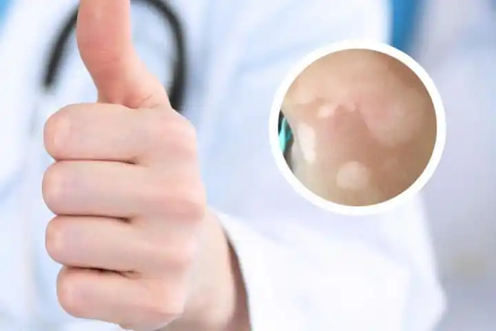 白癞癜风最初几天照片