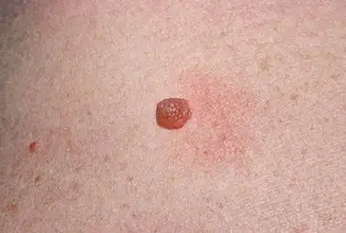 胸部有红痣意味着什么胸部的红痣寓意