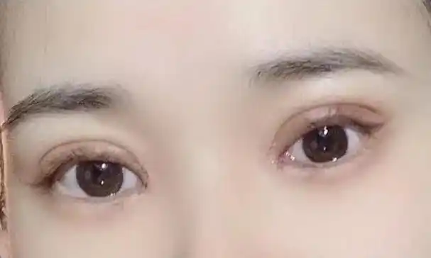 姑娘花10000多割双眼皮,曝出前后对比照,网友直言:勇气可嘉!