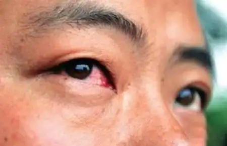 肝好不好全看眼睛,3种情况一出现是肝脏求救,3招教你养肝明目