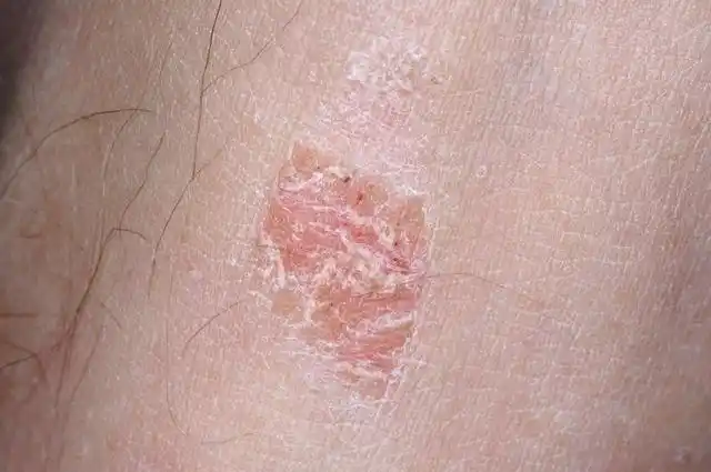 男生阴囊痒湿疹图片