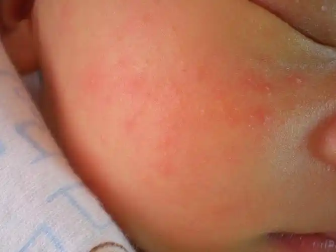 时尚达人-昊哲老师分享:孕妈妈知识普及之胎毒