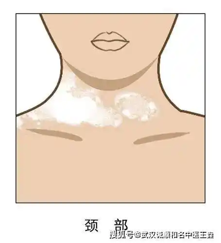 常可见病发部位出现粉红或白色斑块,白斑表面光滑不起屑,在强烈阳光