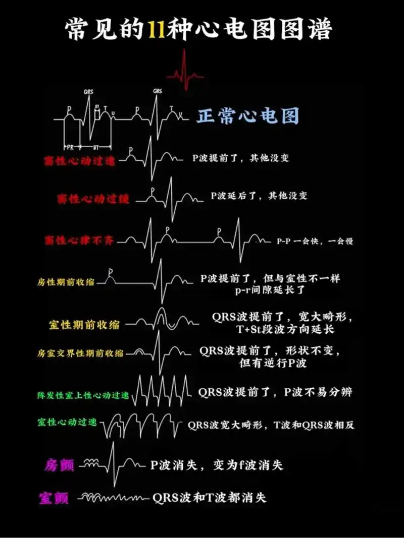 11种常见心电图,心电图查看科普.11种常见心电图,心电图查 - 抖音