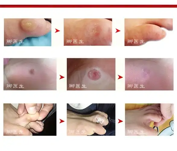 去除鸡眼膏贴脚丁治肉瘊子脚垫脚底老茧厚茧特硬居家日用套装