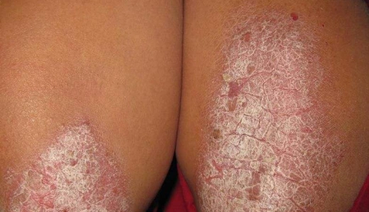 体癣图片_体癣症状表现图片大全_有来医生