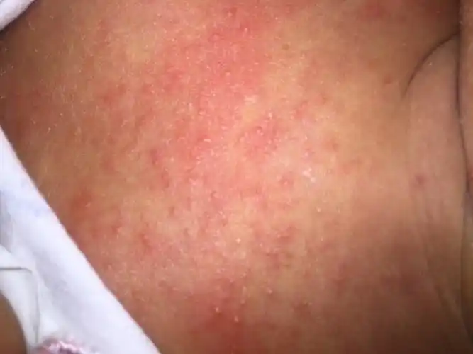 有的还是白头,这是湿疹还是痱子?