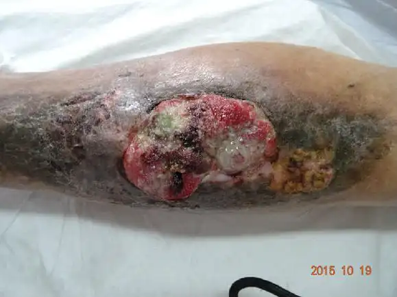 慢性骨髓炎什么时候治疗最好?