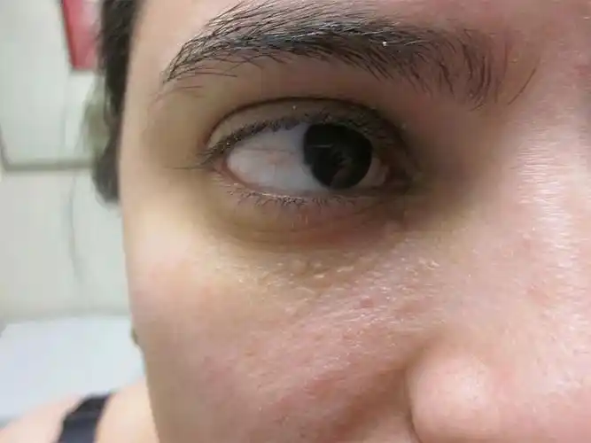 汗管瘤具体症状