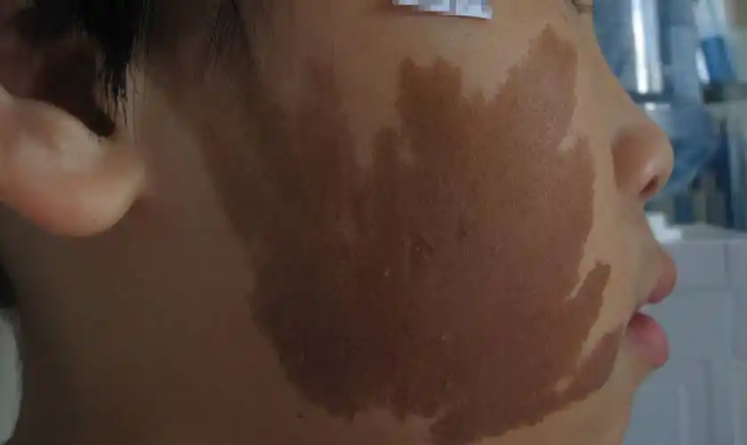 郑州市第二中医院去除咖啡斑的好方法是什么