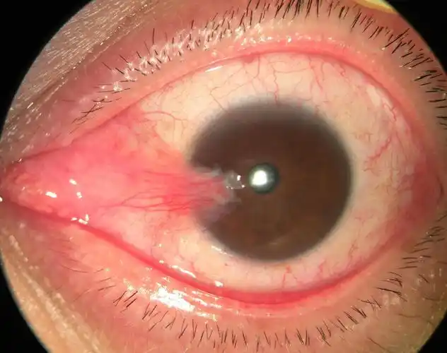 翼状胬肉_疾病介绍_预防_手术_治疗方法_介绍_如何预防_治疗方式