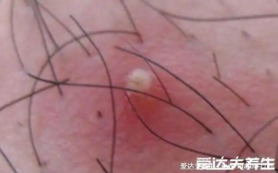 人体100种皮肤病对比图症状及名称,皮肤病种类及对应图片大片