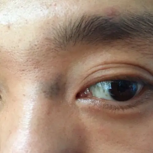 请问各位有人知道这样黑色沉淀怎么去除 我的眼角十年前到现在一直存