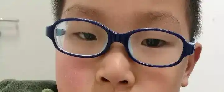 可以看出她的眼球并不小这名小患者,母亲高度近视,导致她很小就2000多