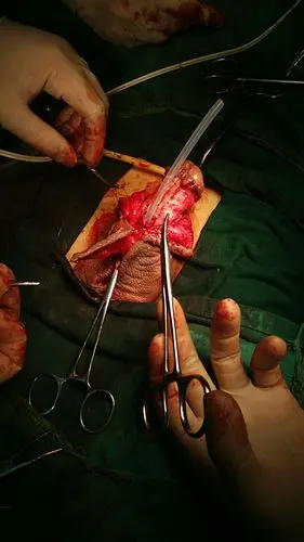 7月38台尿道手术:27台尿道下裂,1台尿道上裂,9台尿道狭窄,1台阴茎假体