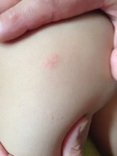 孩子一岁半,屁股上起水泡似的小包,抹婴爽