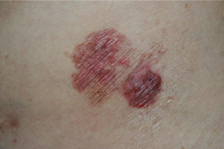 侵袭性鳞状细胞癌诊断:鳞状细胞癌的诊断需要依靠皮肤活检病理.