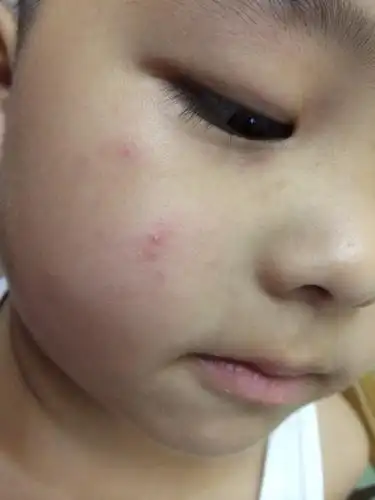 儿子脸上怎么回事?已经3个星期了,不停的冒包,人中几次都这样.是过敏?