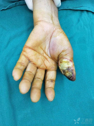 【讨论】拇指外伤术后感染坏疽接力皮瓣修复