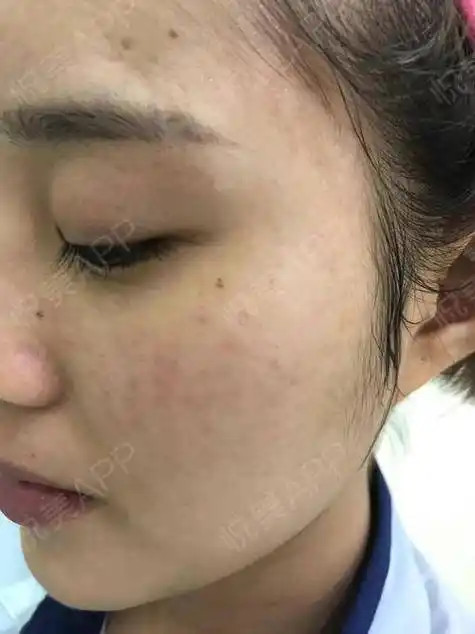 光子嫩肤一到七天图