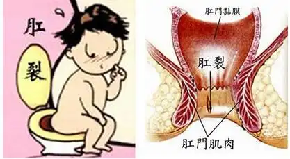 肛裂怎么形成的