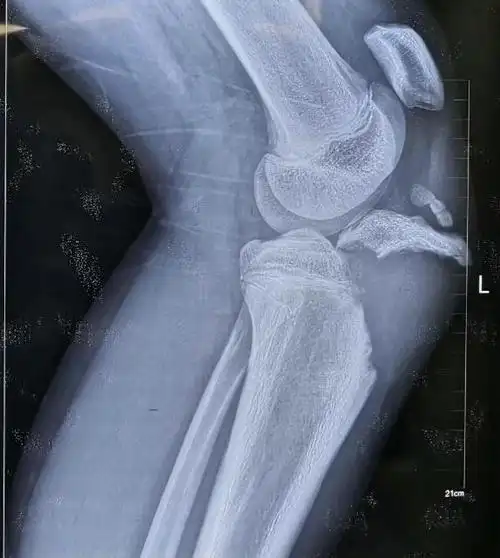 特殊胫骨结节撕脱性骨折手术分享