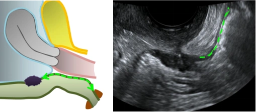 检查方法,当考虑存在严重类型的深部内异症病变或道格拉斯陷凹闭合时