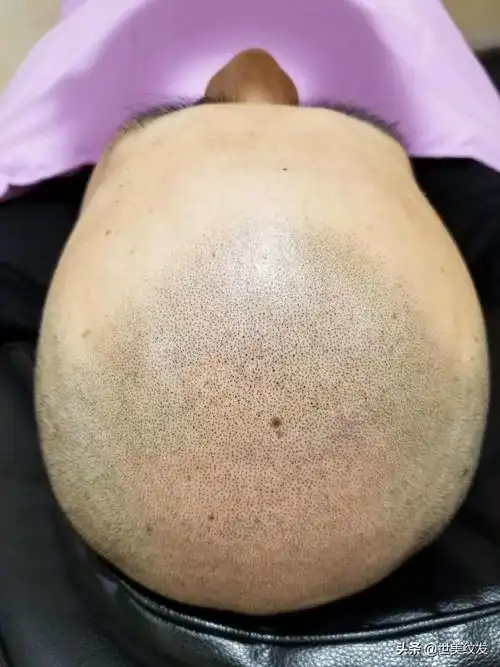 为什么有的男人宁愿脱发秃顶都不愿意理光头