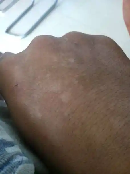 手上长汗斑用什么药能治好?