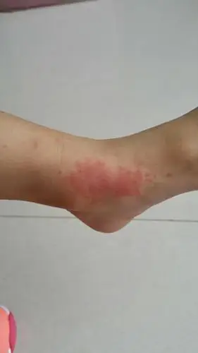 有谁知道过敏性紫癜,我家宝宝得了,怎么办啊?