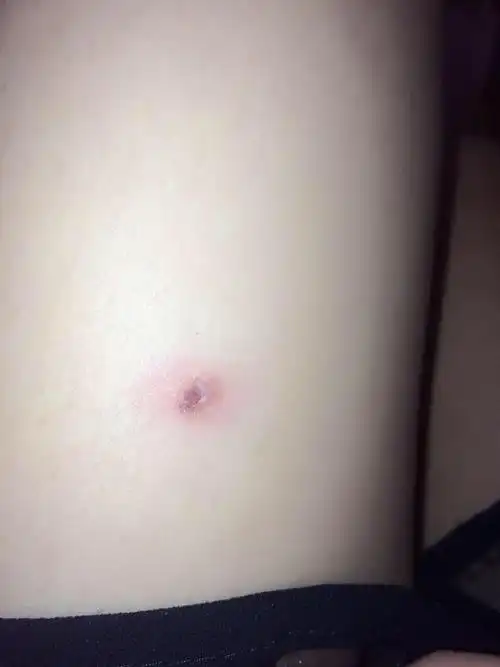 小孩被狗狗给传染了一种不知是癣还是疮的东西?