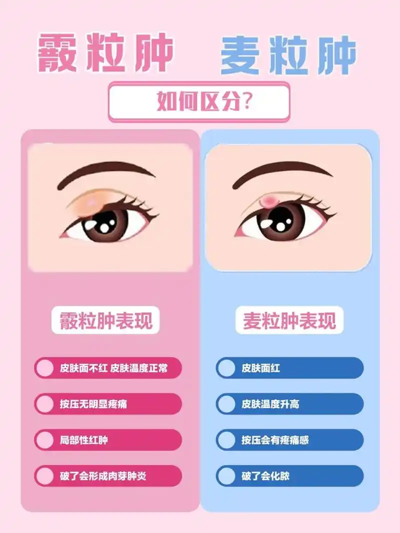 麦粒肿还是霰粒肿71如何区分71 16615霰粒肿(性质为慢性)