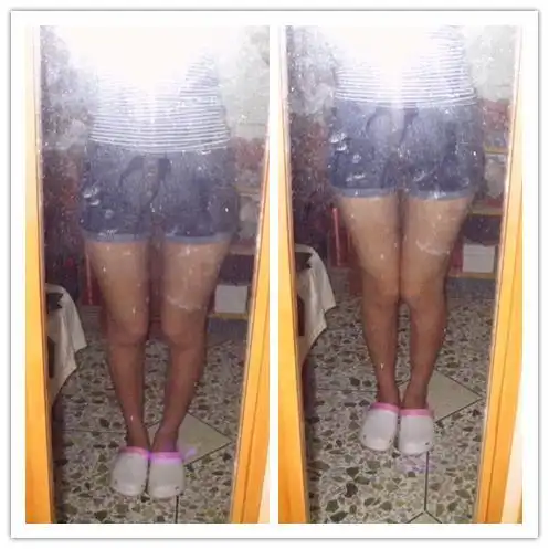 膝内翻如何矫正跪求