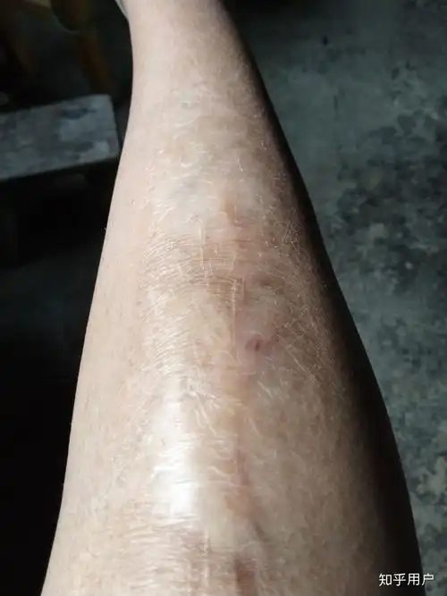 有没有人因腿上有大面积疤,十几年都没穿过短裤短裙?