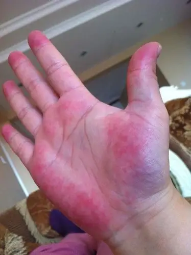 手掌发红